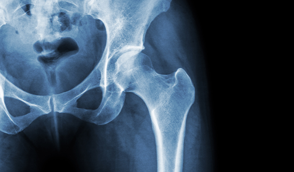 Orthopedic Analysis for Metal Allergies in Joint Replacement